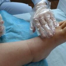 lymphatic drainage therapist